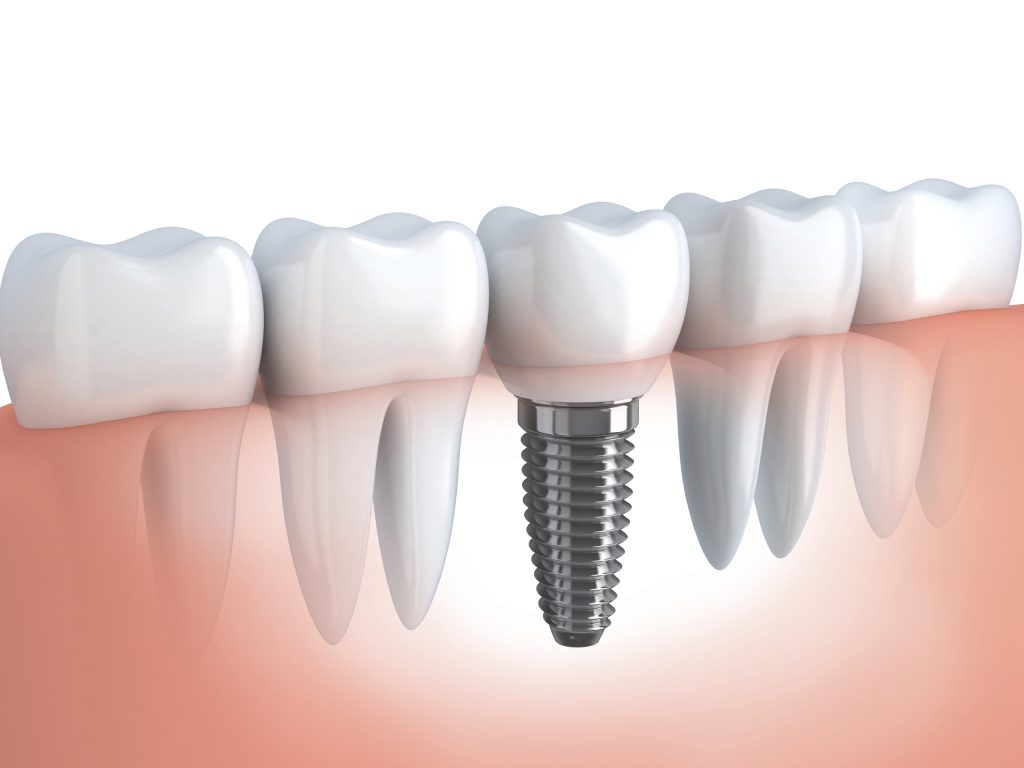 Implant dentar art dental new